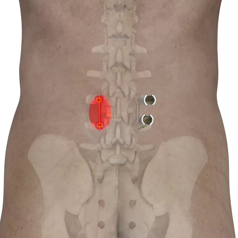 6.0 Thoracolumbar Percutaneous Minimally Invasive Screw & Rod System