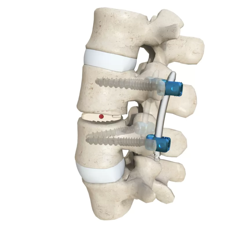 Lumbar Interbody Fusion Cage 