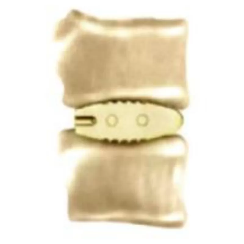 Lumbar Interbody Fusion Cage 