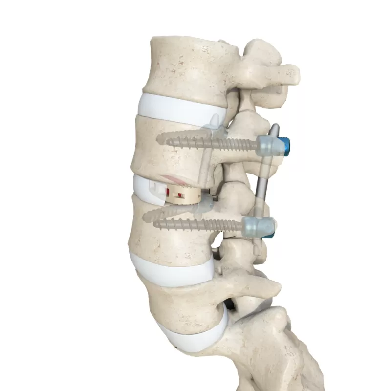 Oblique Lateral Interbody Fusion Cage (OLIF)