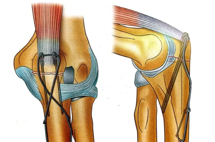 Internal Fixation Techniques for Olecranon Fractures of the Ulna
