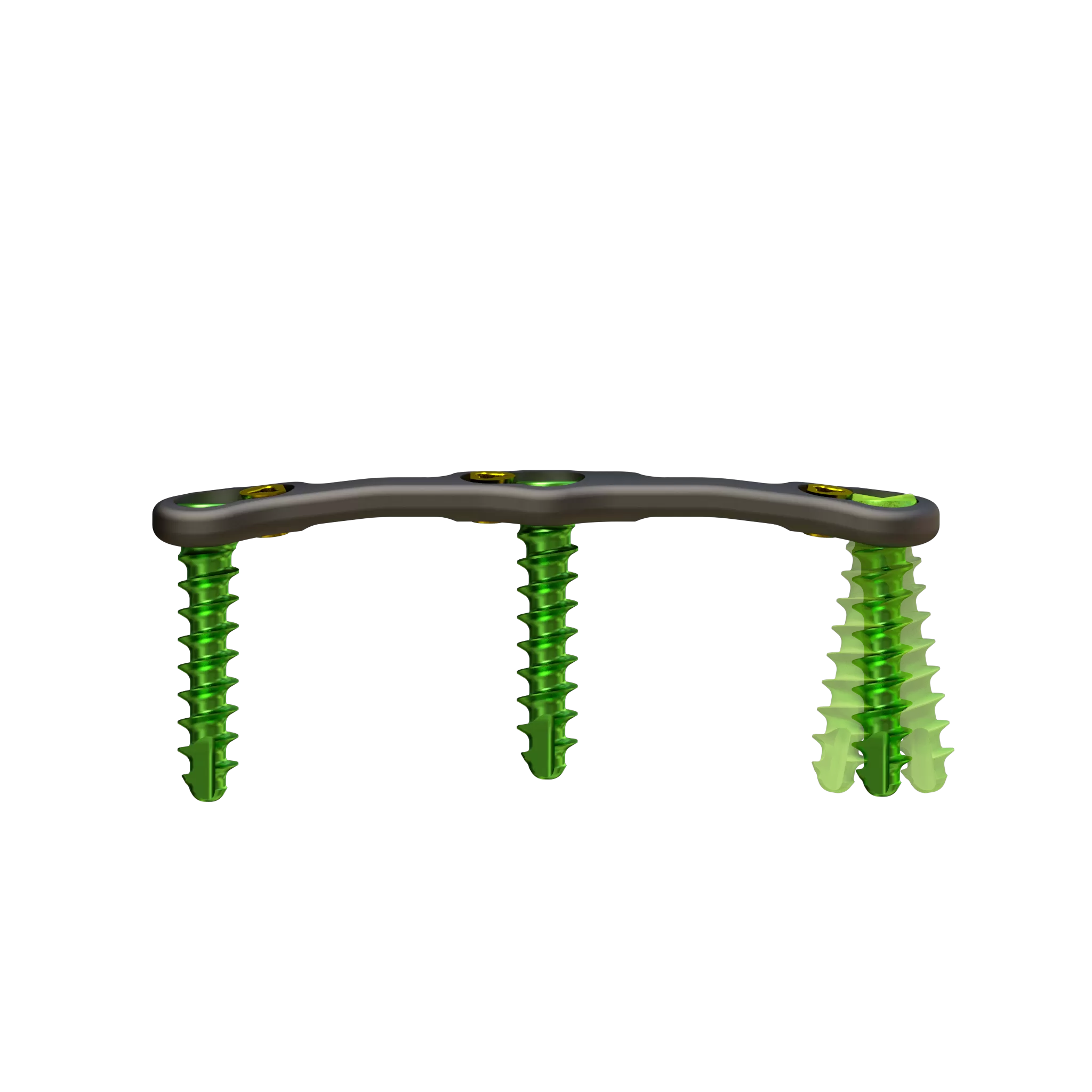 Lateral view of assembled anterior cervical plate system with screws