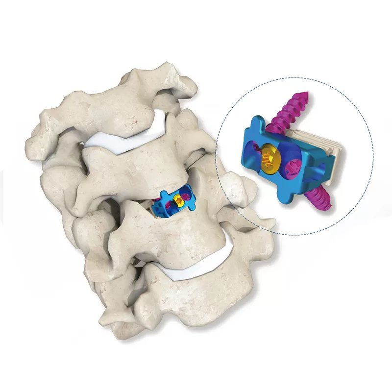 Self-stabilizing Cervical Fusion Cage