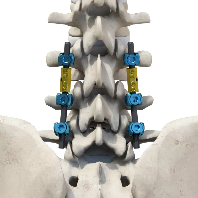 CoCrMo Thoracolumbar Posterior Screw-Rod System 6.0
