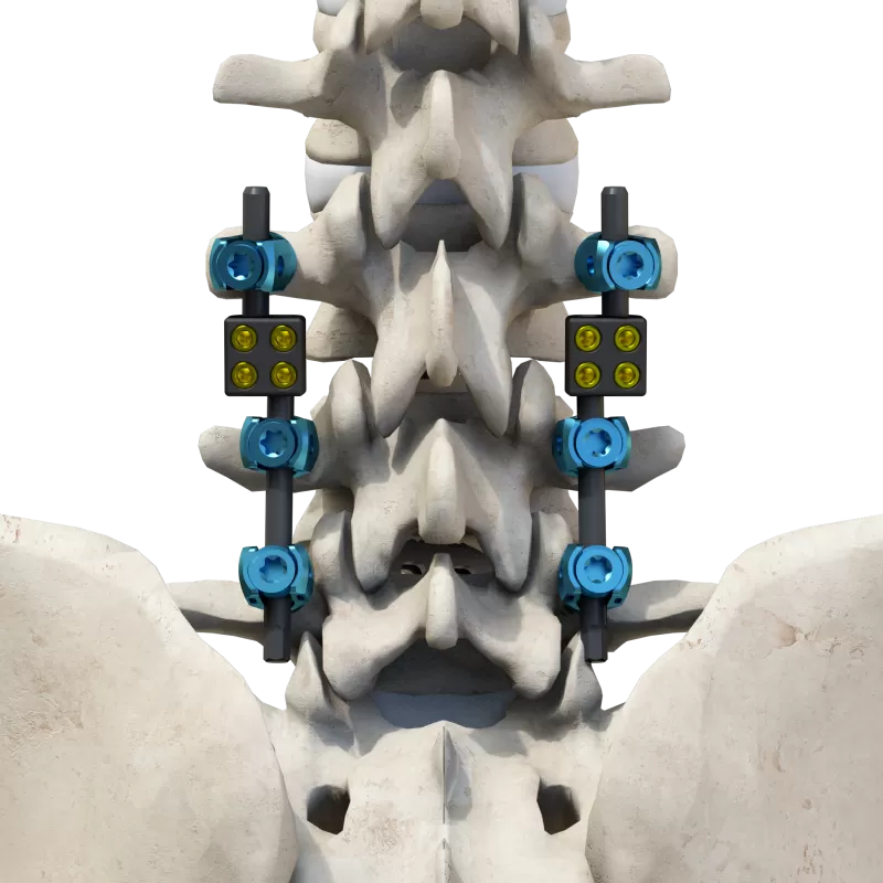Thoracolumbar Posterior Pedicle Screw and Rod System（5.5/6.0）