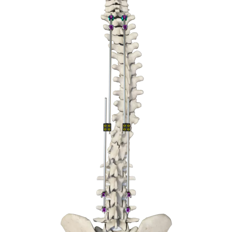 Thoracolumbar Posterior Pedicle Screw and Rod System（5.5/6.0）