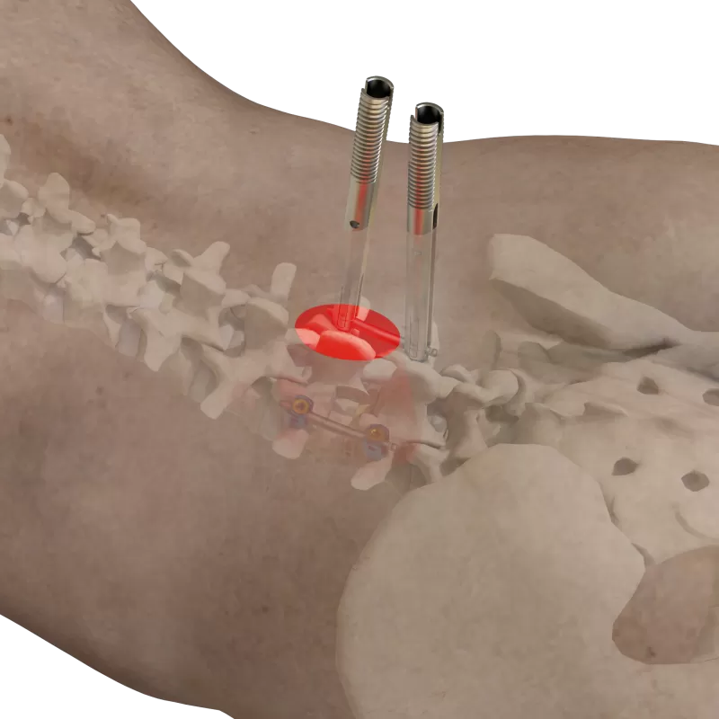 Thoracolumbar Percutaneous Minimally Invasive Screw & Rod System