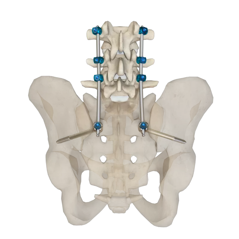 5.5 Thoracolumbar Percutaneous Screw & Rod System - Sacroiliac