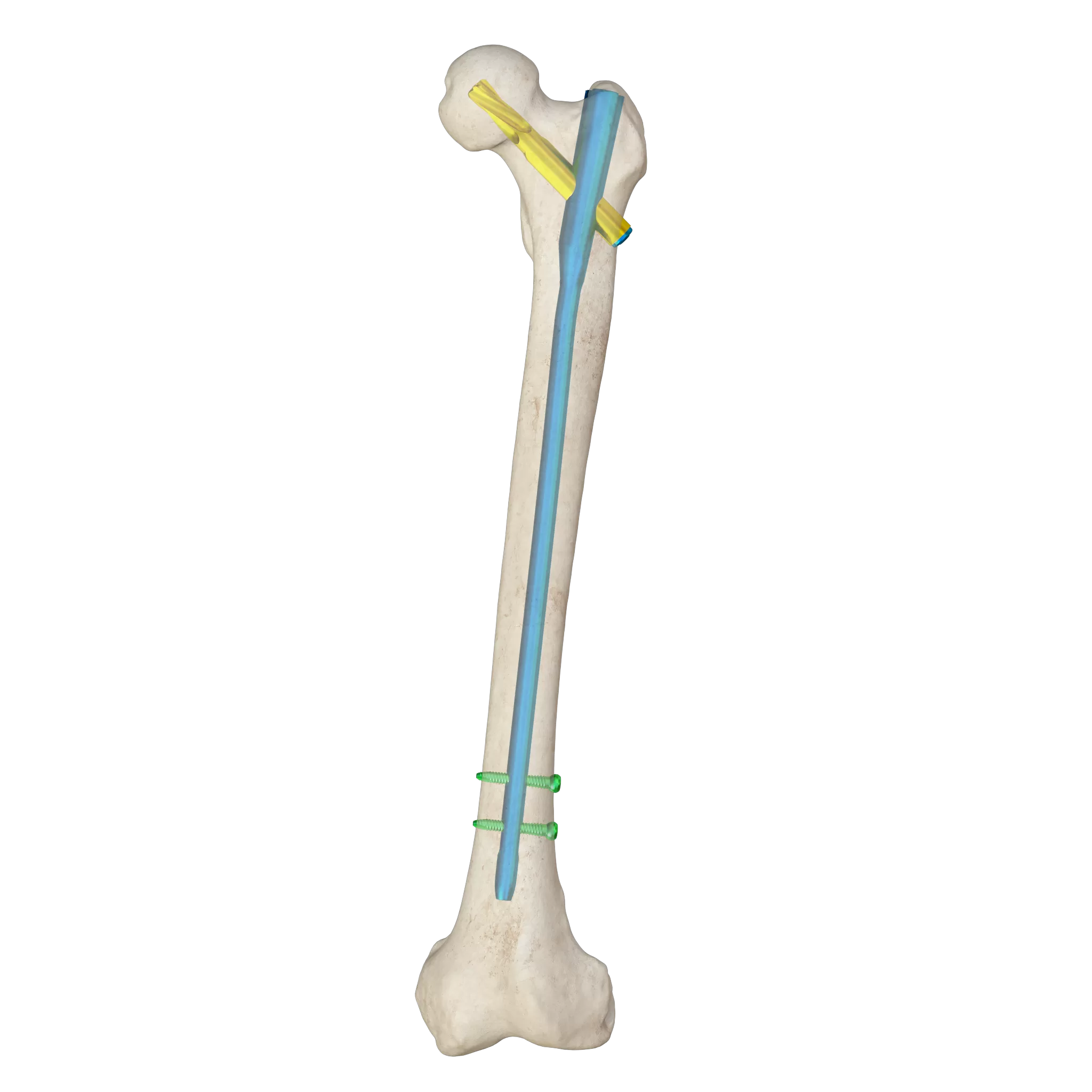 Proximal Femoral Nail Type I – Double Lag Screw