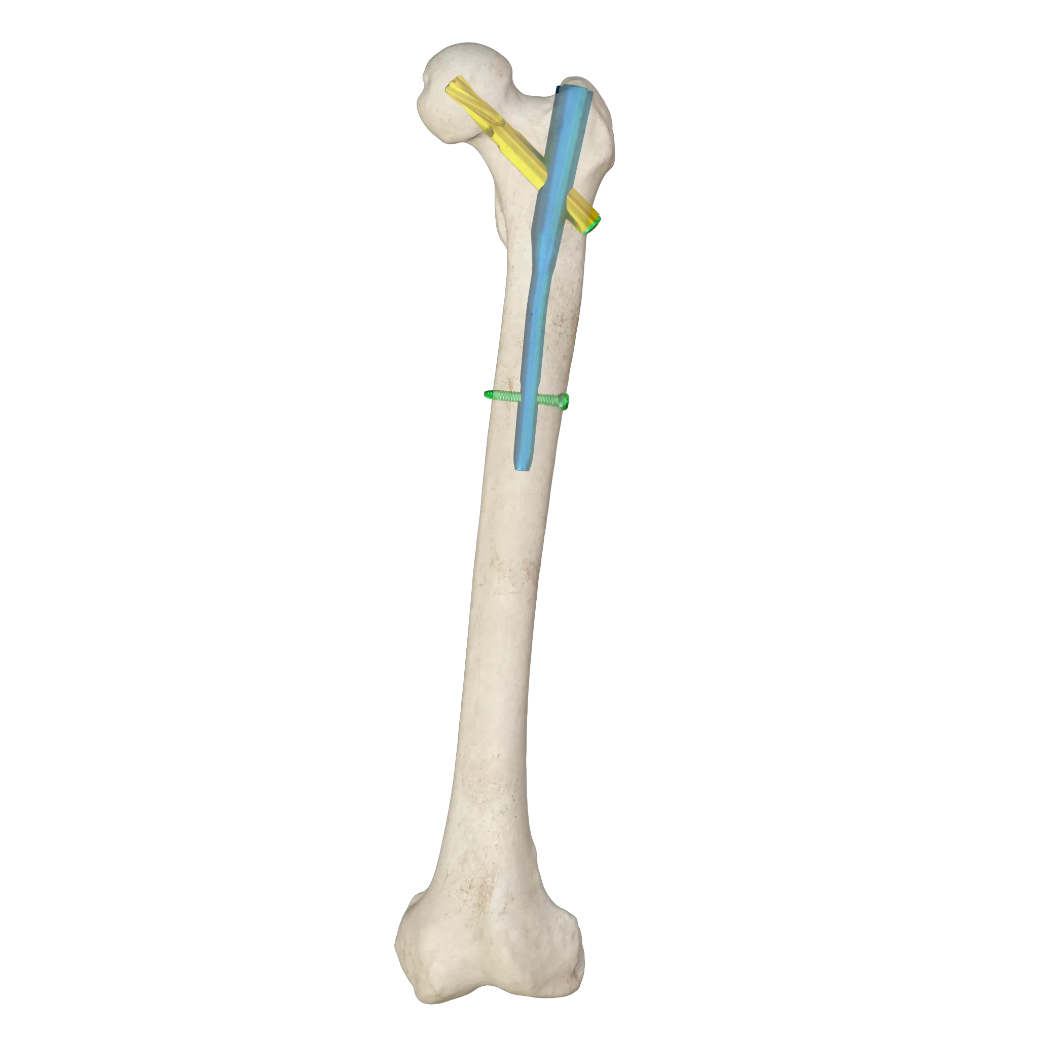 Proximal Femoral Nail Type I – Double Lag Screw