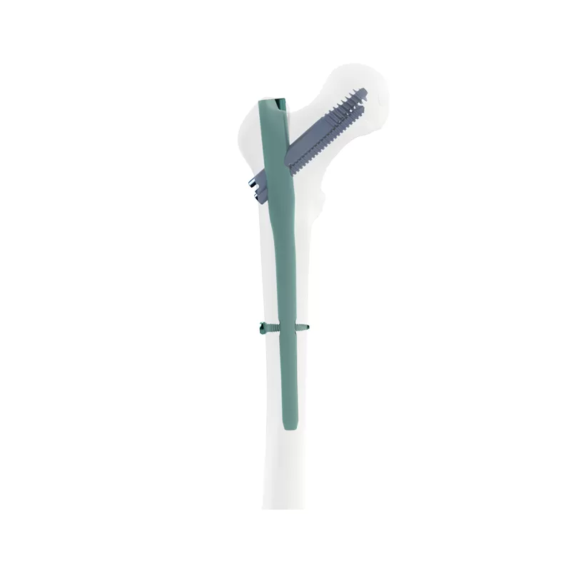 Proximal Femoral Nail Type II – Double Lag Screw