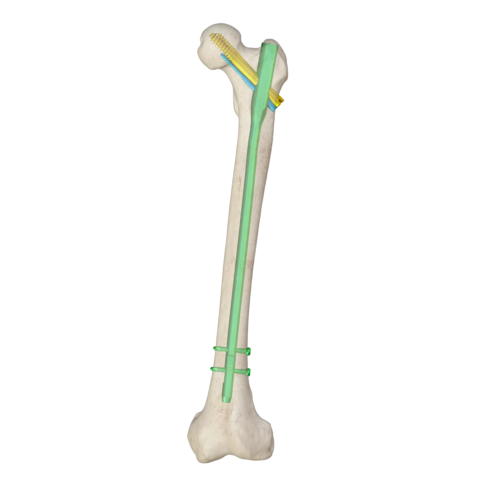 Proximal Femoral Nail Type II – Triple Screw Design (Intertan)