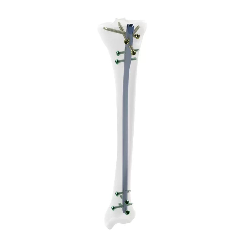 Tibial Intramedullary Nail