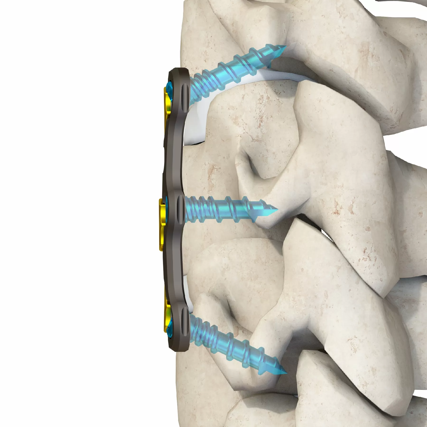 Anterior Cervical Plate