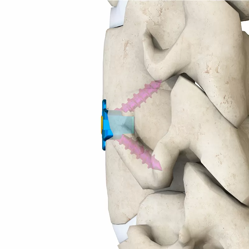 Cervical Interbody Fusion Cage (2 Screws)