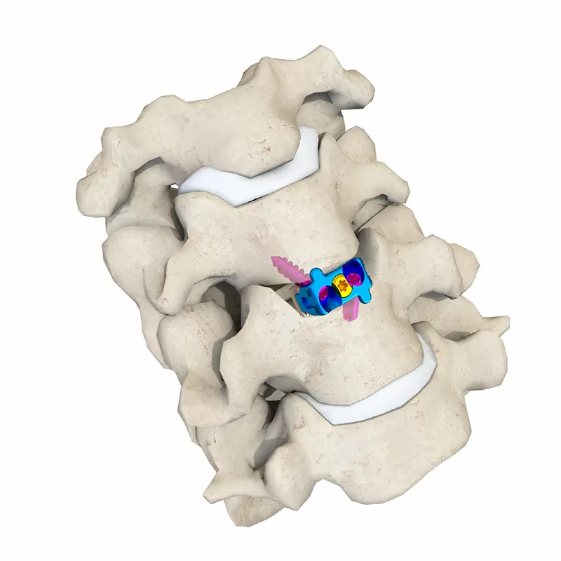 Cervical Interbody Fusion Cage (2 Screws)