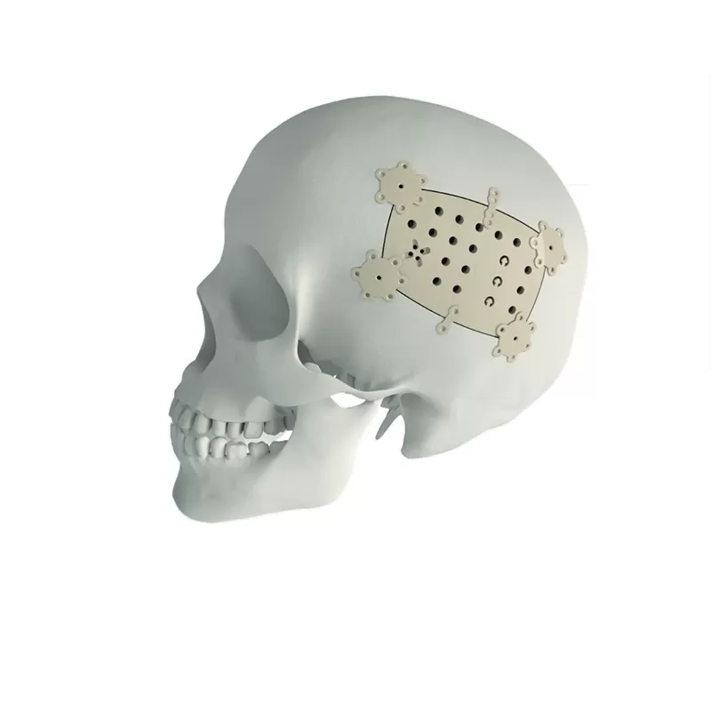 PEEK Cranial Repair