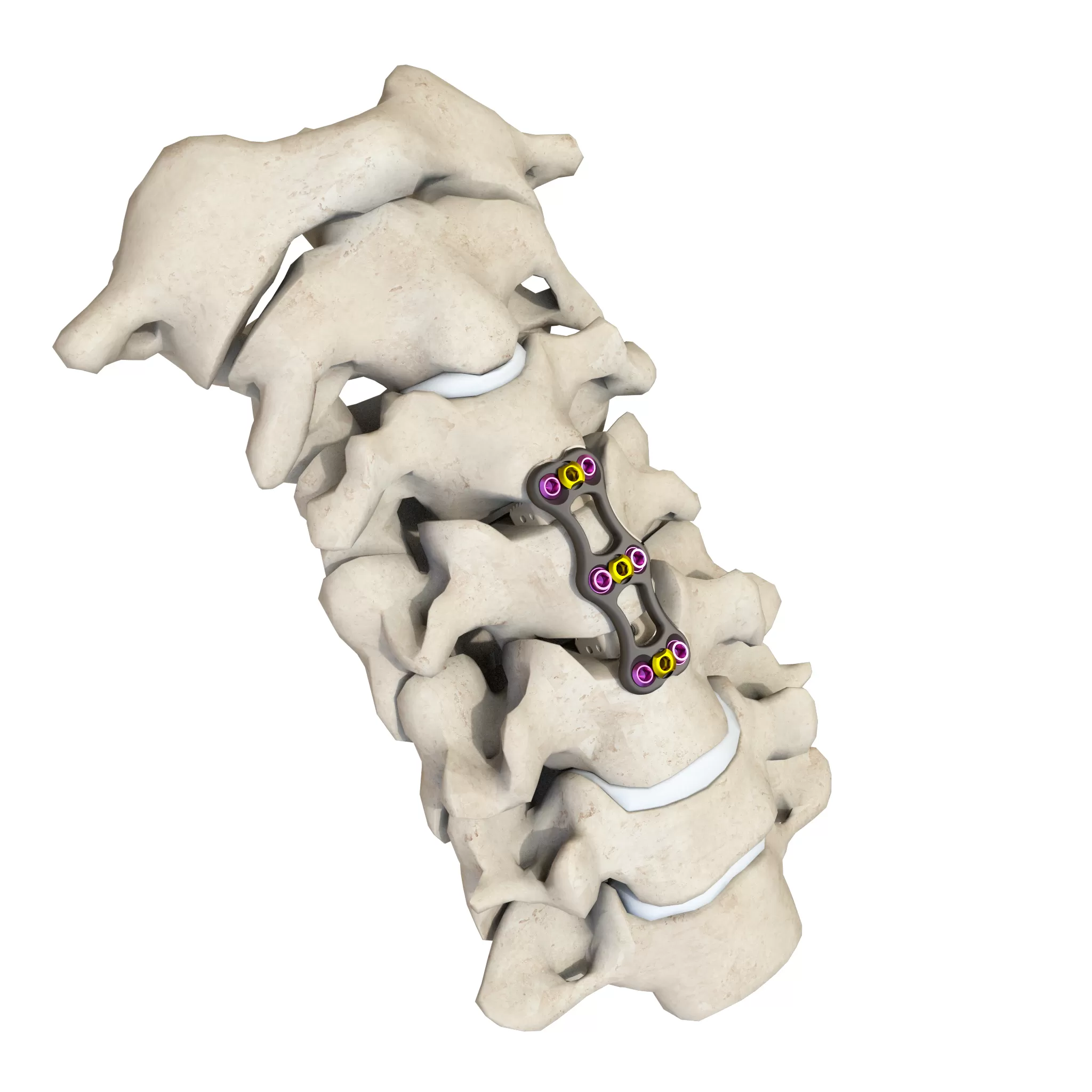 Anterior Cervical Plate - Type II