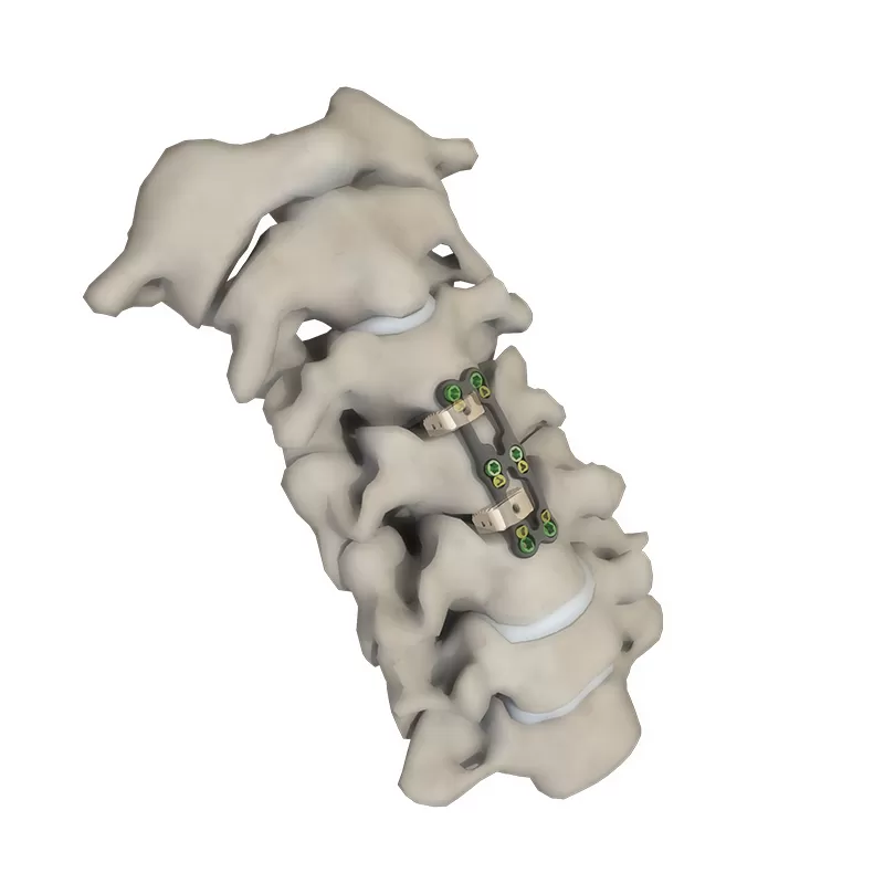 Cervical Interbody Fusion Cage