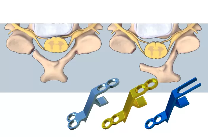 Lamina Fixation System