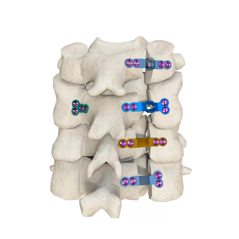 Open Door Titanium Cervical Laminoplasty System