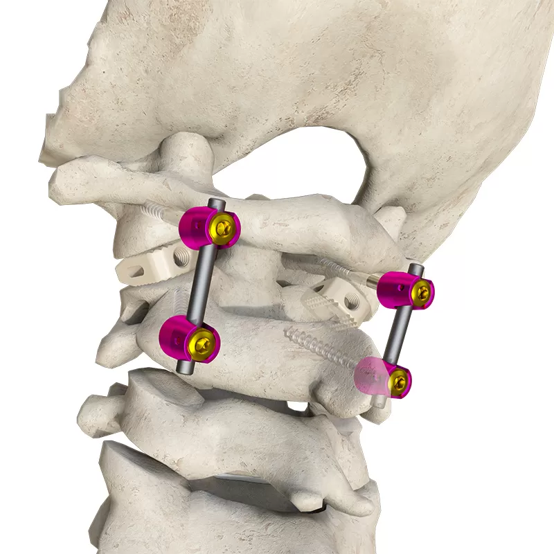 Posterior occipital-cervical-thoracic spinal system