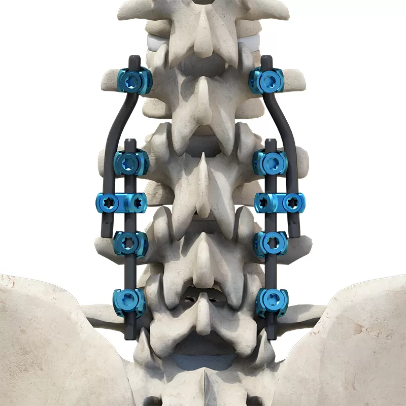 Adjacent Segment Disease Revision Surgery