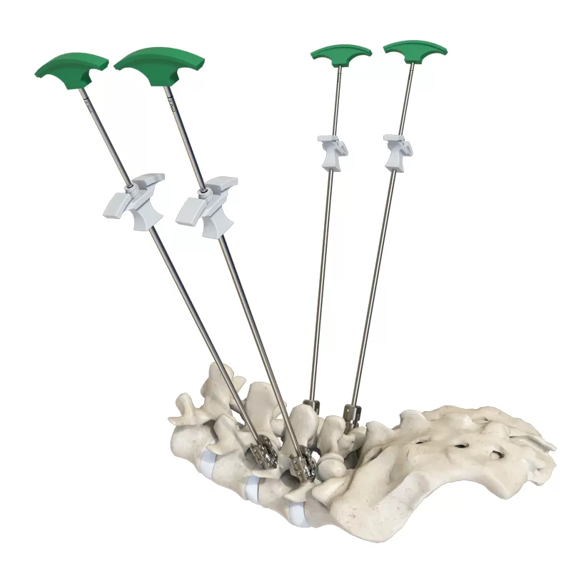 Cement-Augmented Polyaxial Screw III