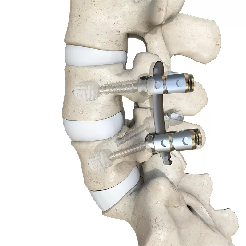 Cement-Augmented Polyaxial Reduction Screw Type IV