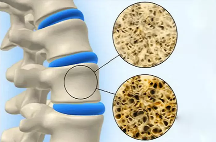 What surgery do you need when you find out you have a fracture with osteoporosis?