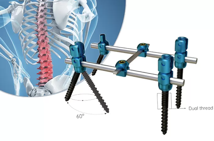MIS percutaneous minimally invasive cannulated nail system