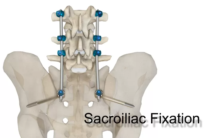 Thoracolumbar Percutaneous Screw & Rod System - Sacroiliac