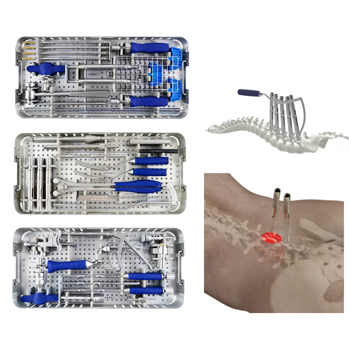 5.5 mm percutaneous TL screw-rod fixation Instruments (rigid)