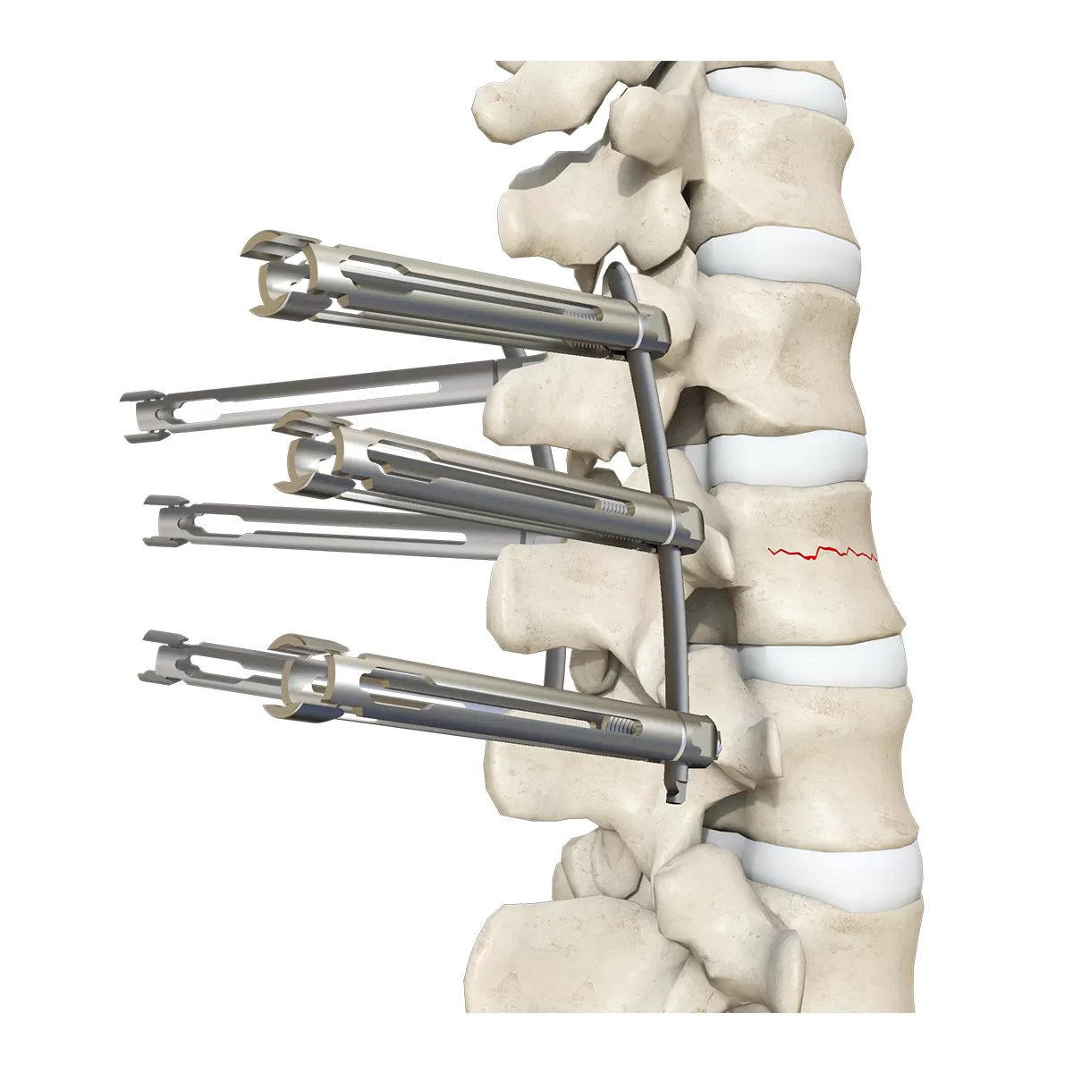 Sequential Dilator 70mm