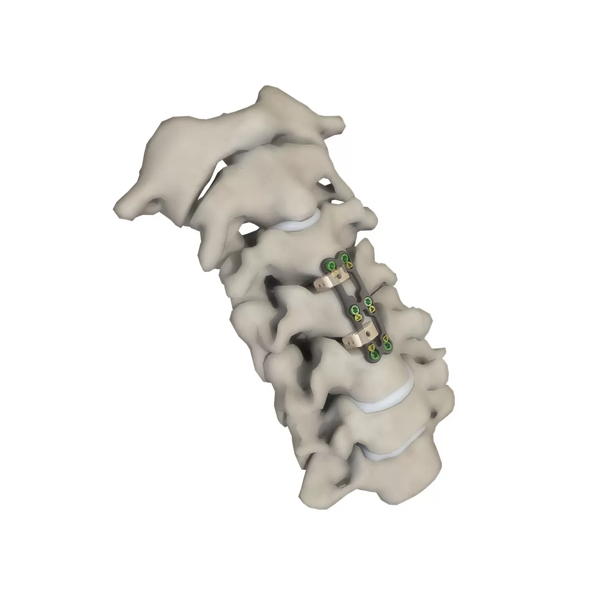 Cervical Interbody Fusion Cage Instrument Set