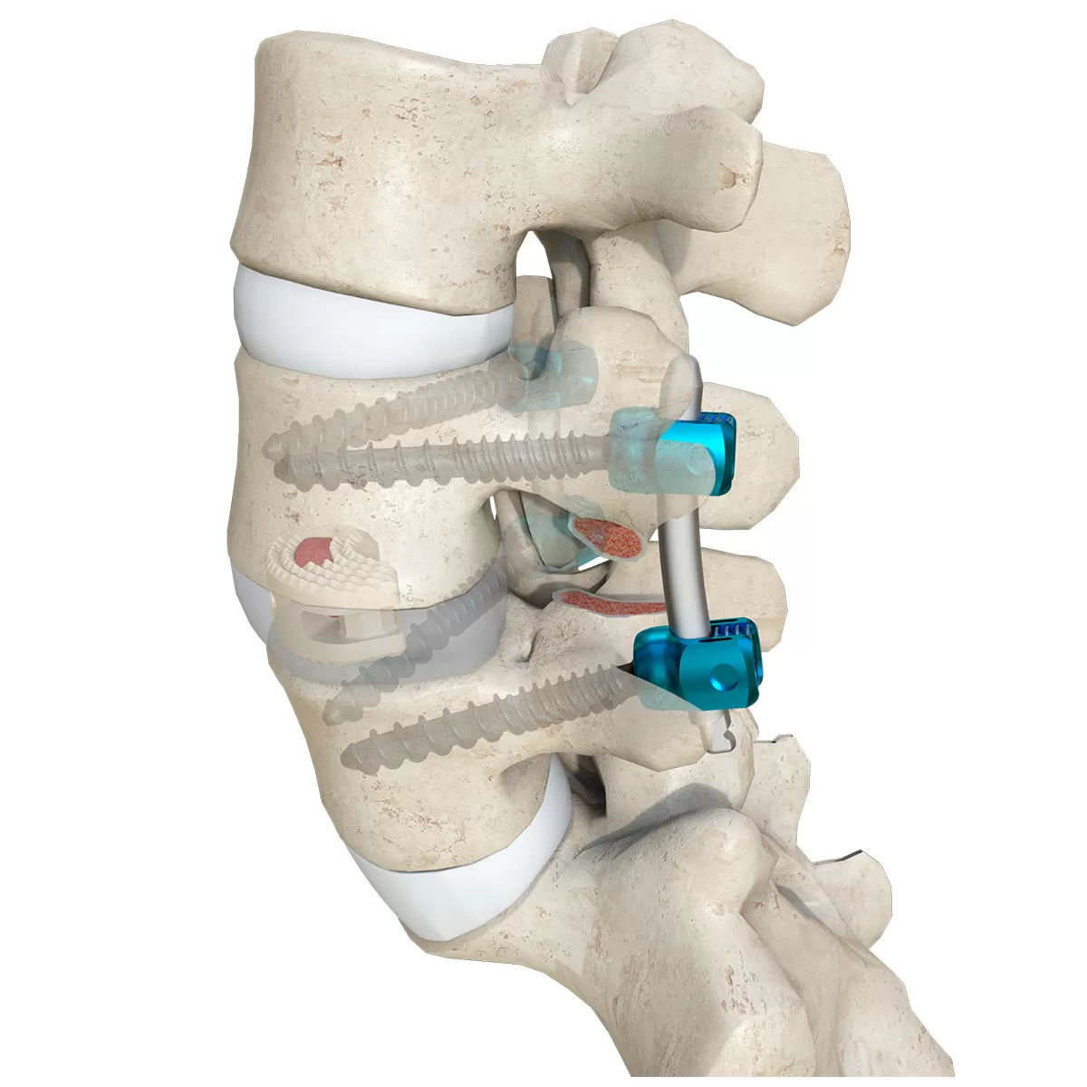 TLIF Interbody Cage Instrument Set - II