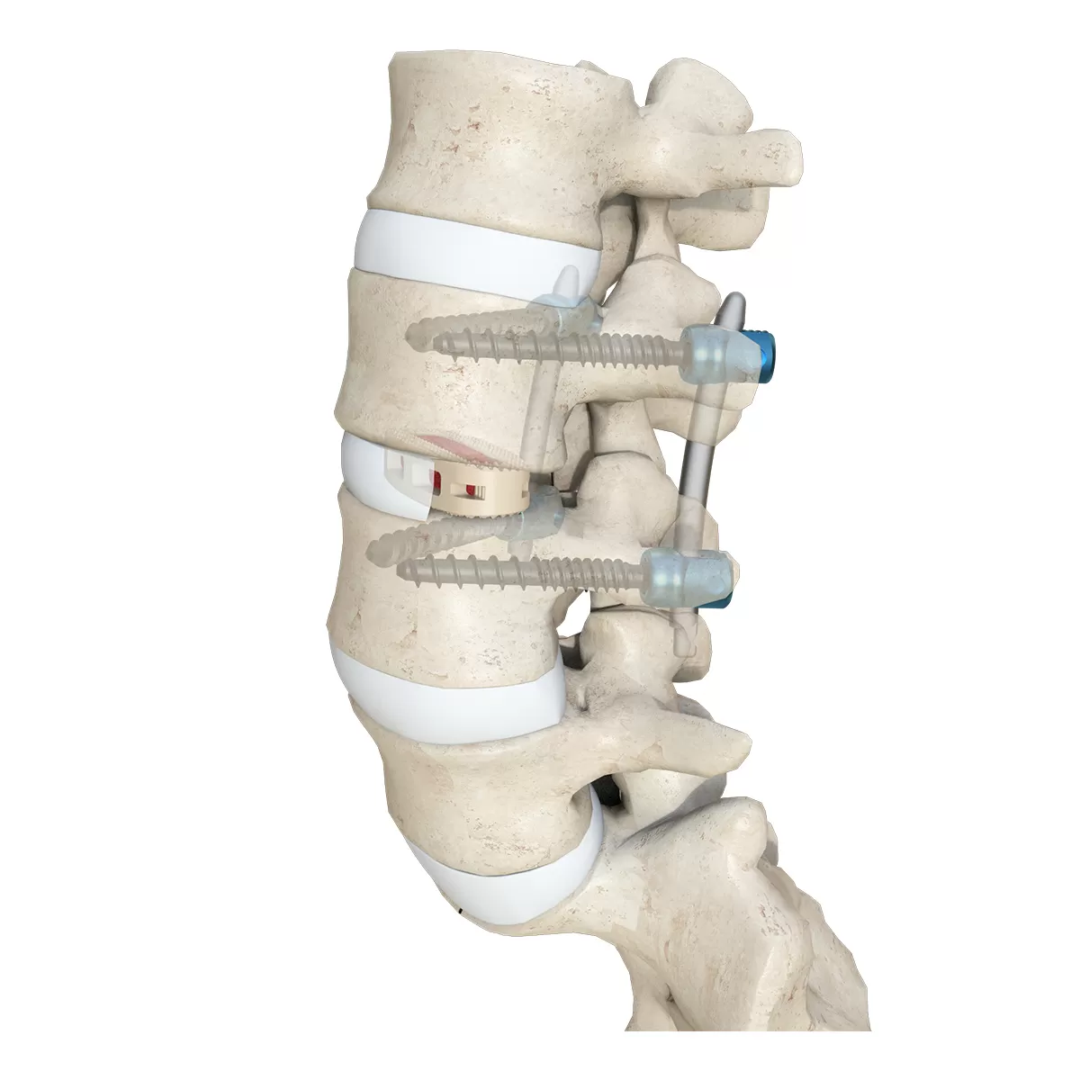 Nerve Root Retractor