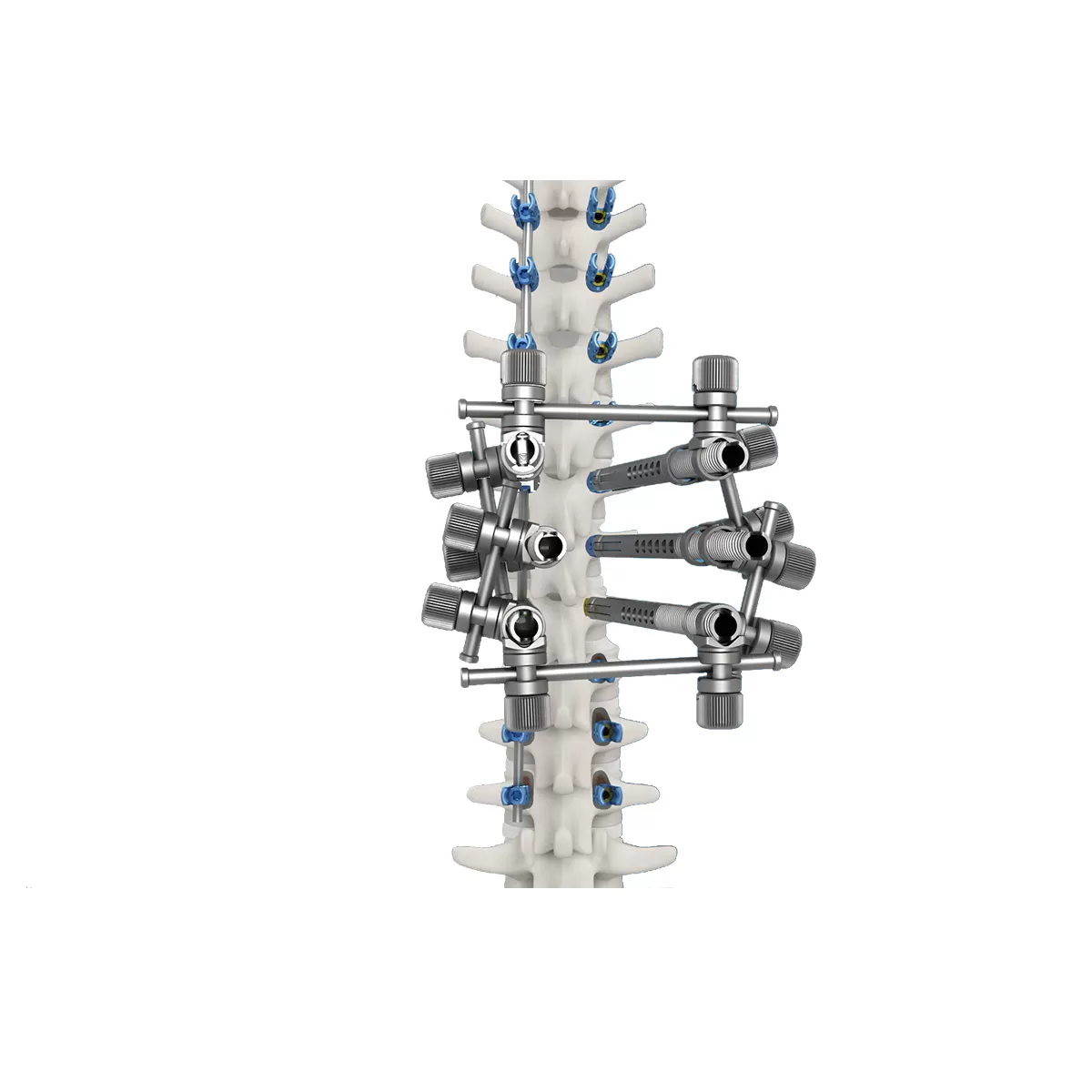 Spondylolisthesis Reduction Ball Nut