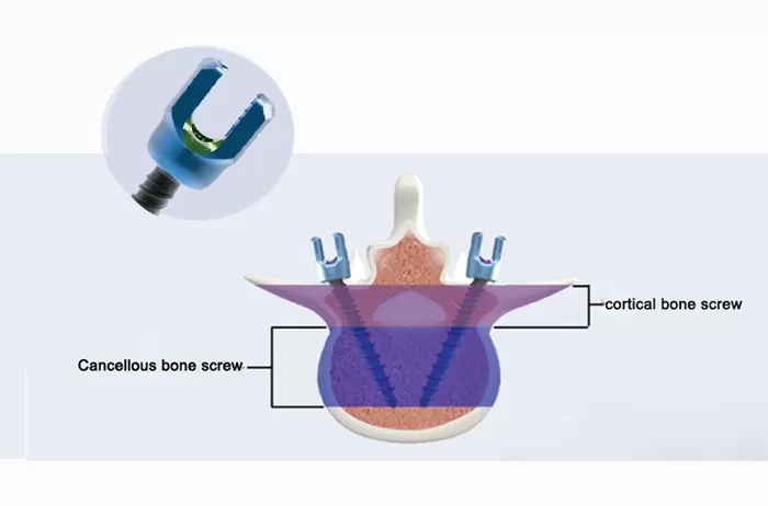 Decompression Fusion System