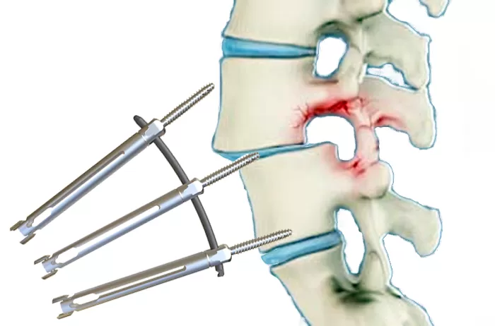 Application of minimally invasive posterior thoracolumbar screw-rod system in lumbar spondylolisthesis