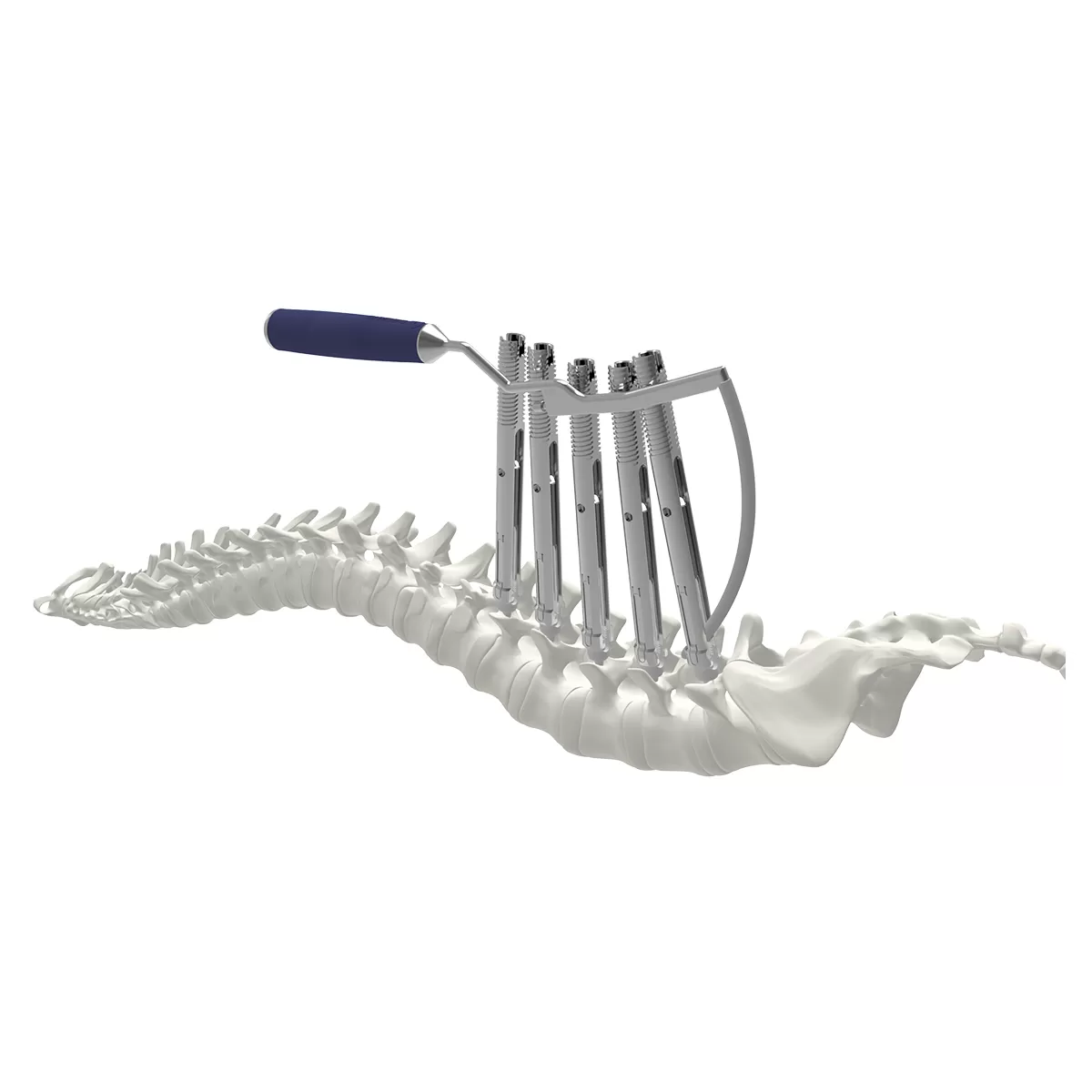 Ti MIS Percutaneous System 5.5