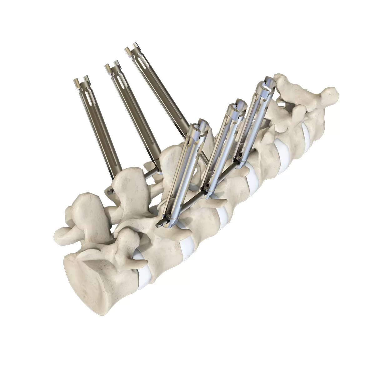 Fixed-Head Screw, Type III