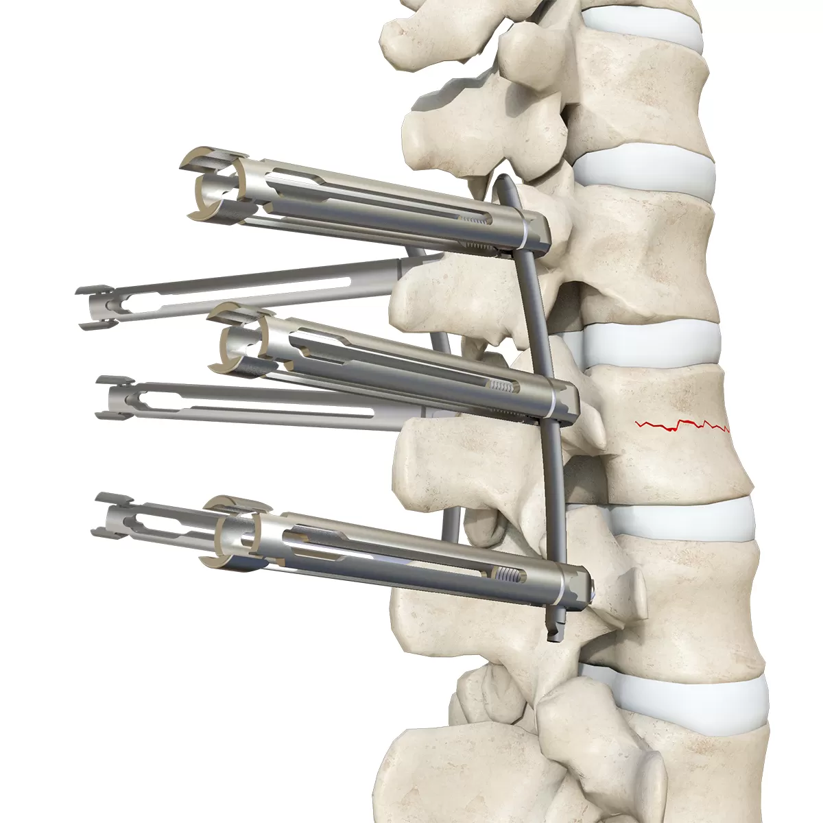 Fixed-Head Screw, Type III
