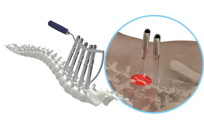 Application of minimally invasive posterior thoracolumbar screw-rod system in lumbar spondylolisthesis