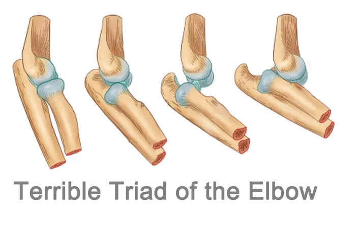 Classification and surgical treatment of the terrible triad of the elbow