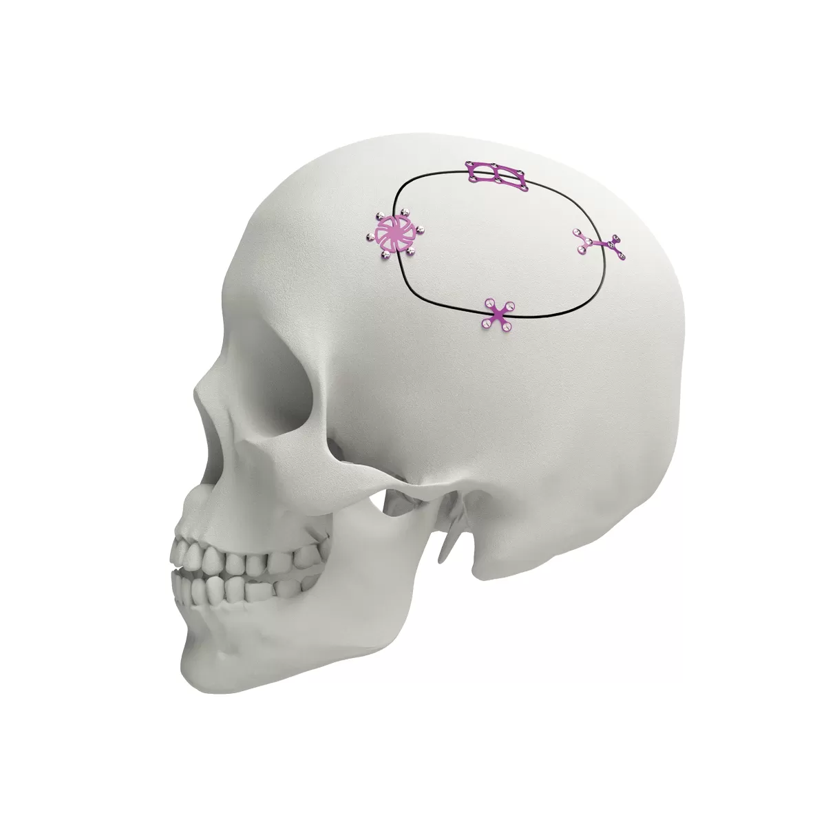 Low Profile Cranial Plating & Screw System