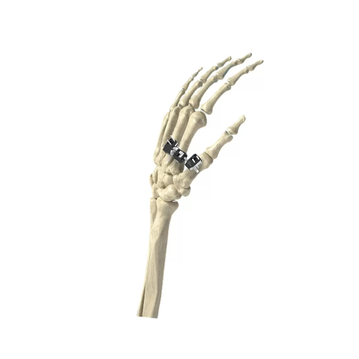 Mini External Fixator