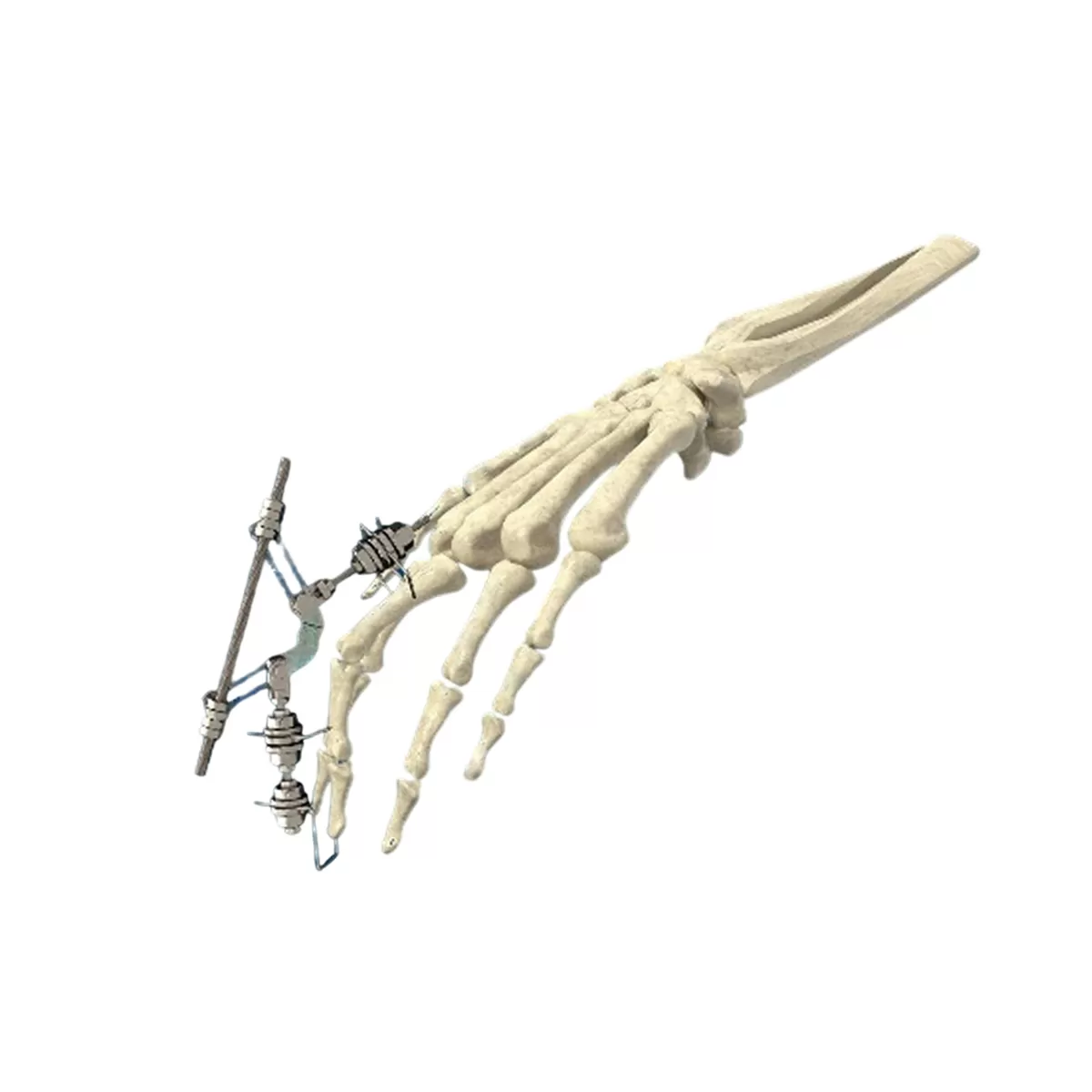 Phalanx External Fixator