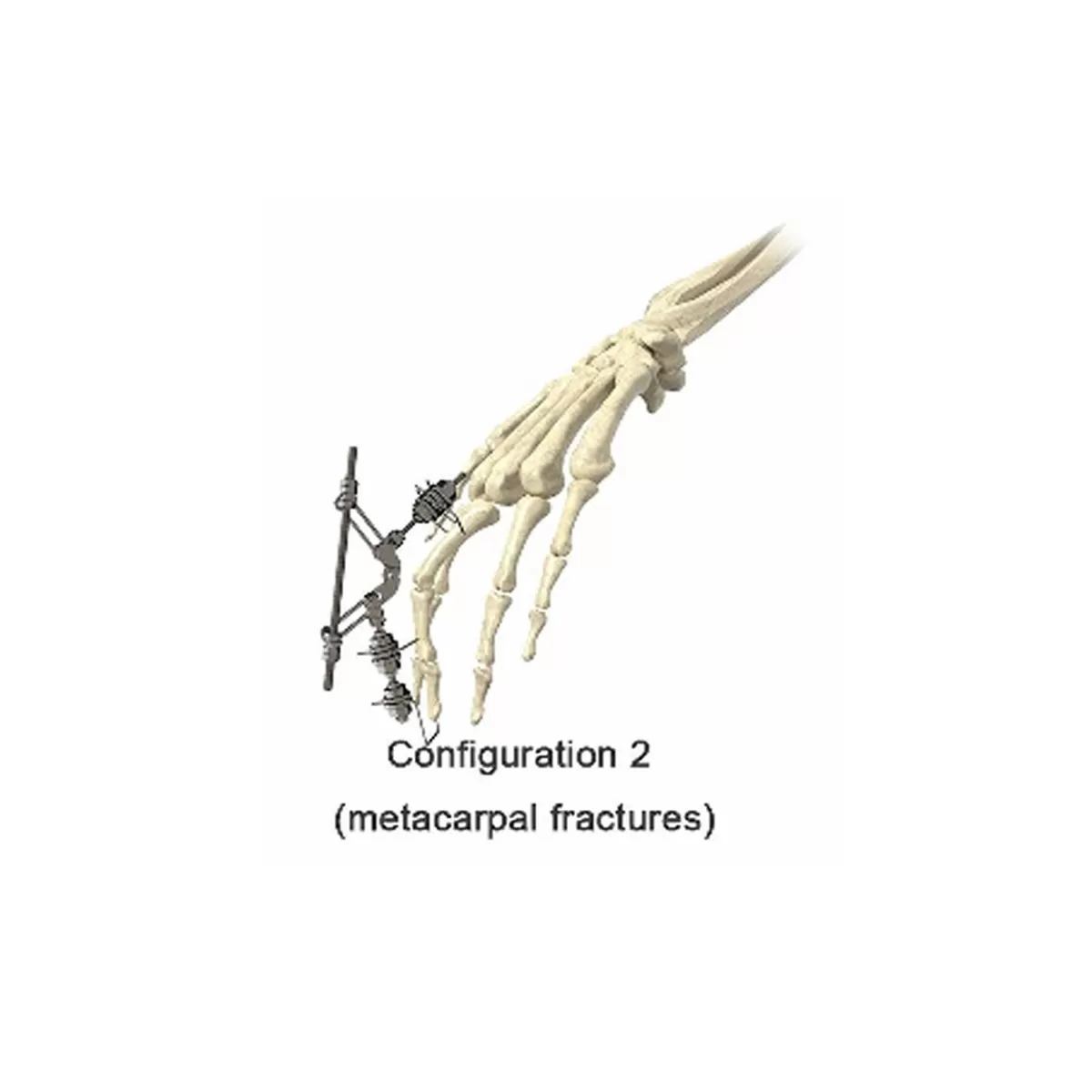 Phalanx External Fixator