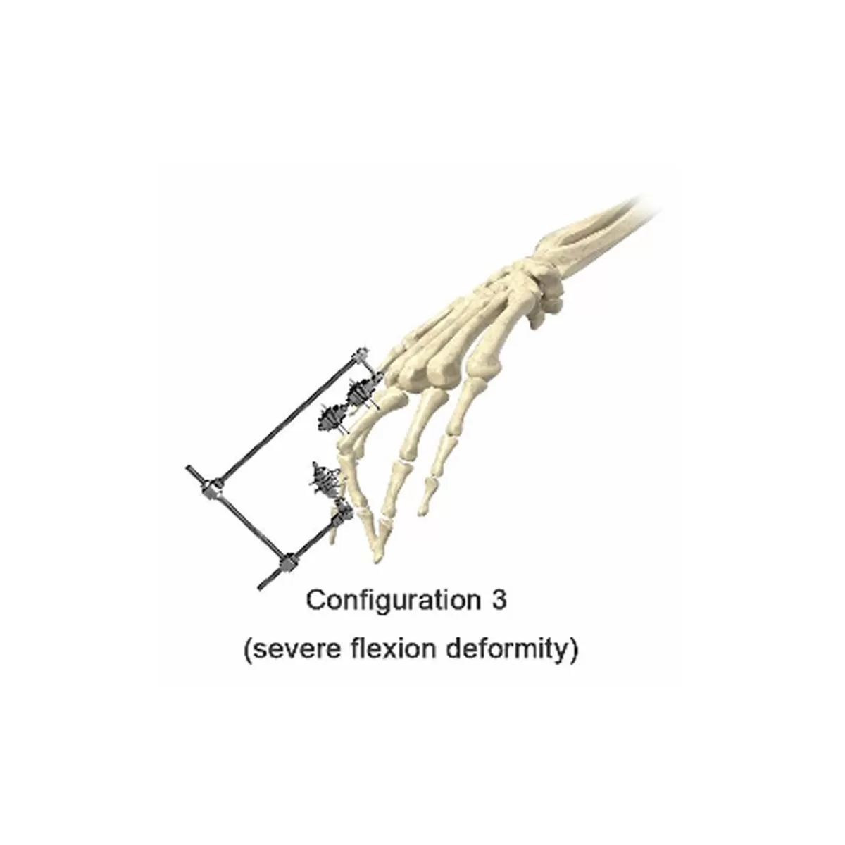 Phalanx External Fixator